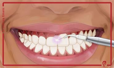 آیا لیفت لثه با لیزر برای همه مناسب است؟